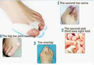 10 párov Silikónový gél prst oddeľovač nohy starostlivosť nástroj palec valgus bunion štít nastavovač úľavu od bolesti narovnať ohnuté prsty FT02-10